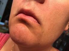 Beard Growth Treatment
