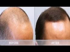 Beard Growth Treatment