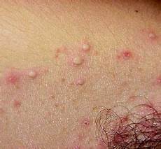 Cholesterol Hair Treatment