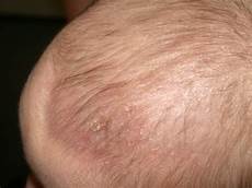 Dandruff Shampoo