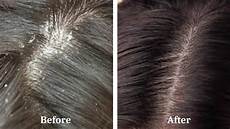 Dandruff Shampoo