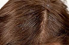 Dry Shampoo