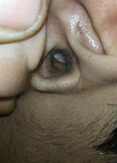 Ear Cleaning Stick