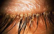 Eye Shampoos