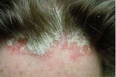 Flaky Scalp Treatment