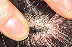 Flaky Scalp Treatment