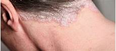 Flaky Scalp Treatment