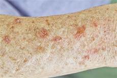 Flaky Scalp Treatment