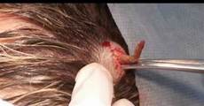 Hair Scalp Treatment