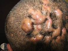 Hair Scalp Treatment