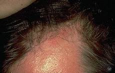Hair Scalp Treatment