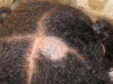 Hair Scalp Treatment