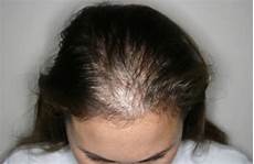 Hair Thickening Treatment