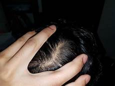 Hair Thinning Treatment