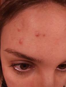 Moisturizer