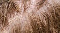 Natural Scalp Treatment