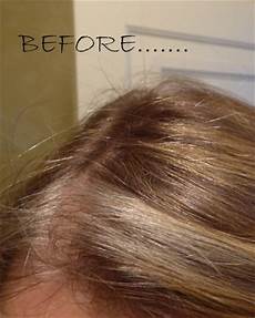 Nioxin Scalp Treatment