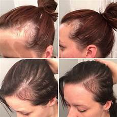 Normal Hair Shampoo