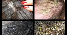 Oily Scalp Treatment