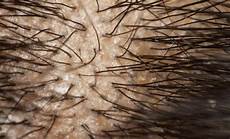 Oily Scalp Treatment