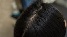 Oily Scalp Treatment