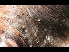 Scalp Care