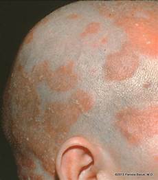 Scalp Cleansing Treatment