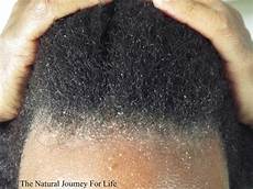 Scalp Cleansing Treatment