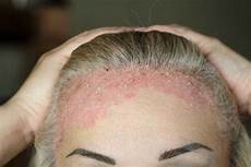 Scalp Therapy