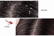 Scalp Therapy