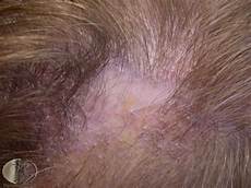 Scalp Treatment