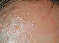 Scalp Treatment