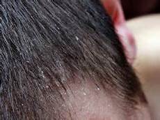 Sensitive Scalp Treatment
