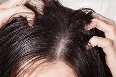 Sensitive Scalp Treatment