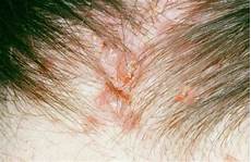 Sensitive Scalp Treatment