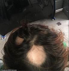 Wen Hair Loss